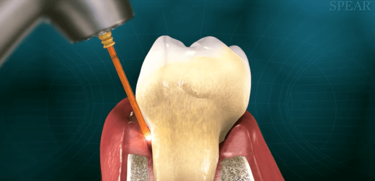 Laser Assisted Treatment