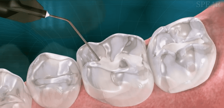 Oral Cancer Screening